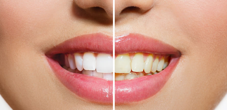 Teeth Whitening Perth